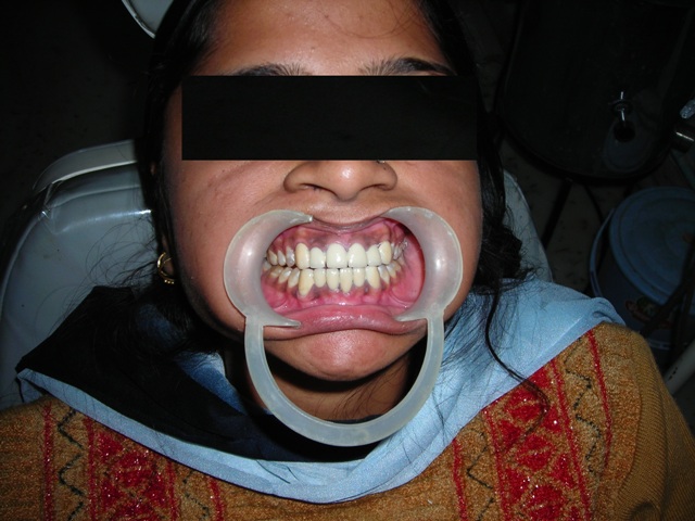 Missing Teeth Predict Strokes