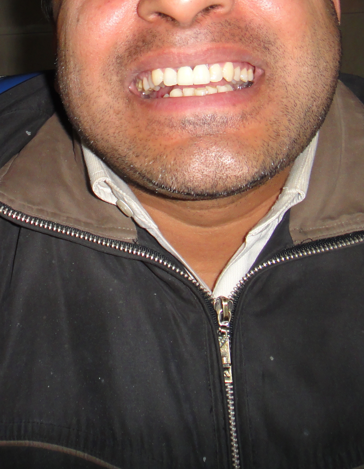 Missing Teeth Predict Strokes