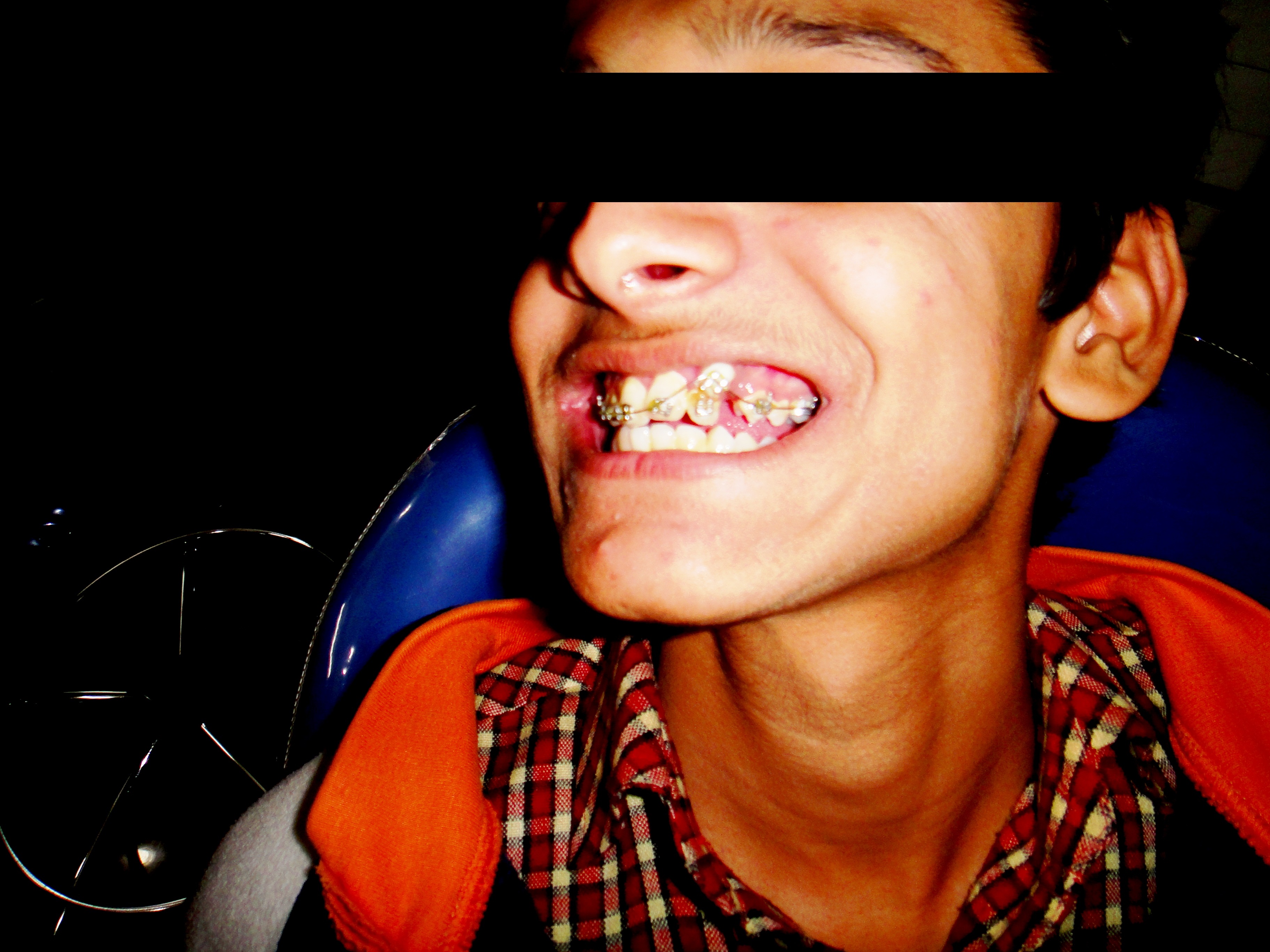 Missing Teeth Predict Strokes