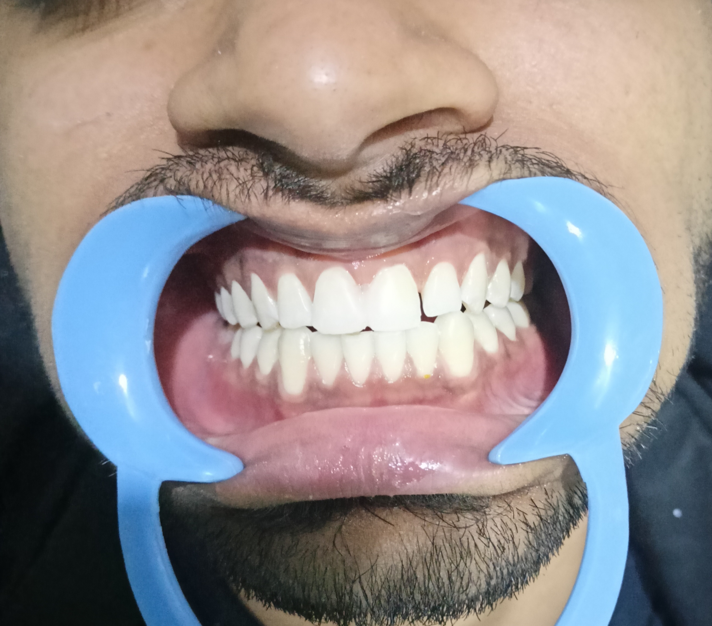 Missing Teeth Predict Strokes