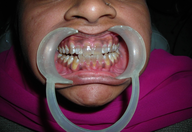 Missing Teeth Predict Strokes