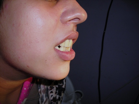 Missing Teeth Predict Strokes