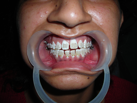 Missing Teeth Predict Strokes