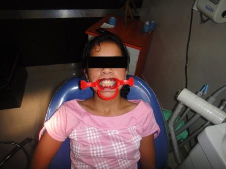 Missing Teeth Predict Strokes