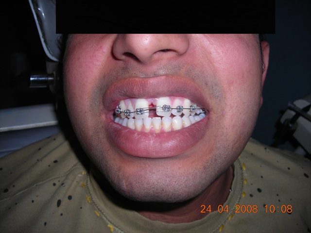 Missing Teeth Predict Strokes