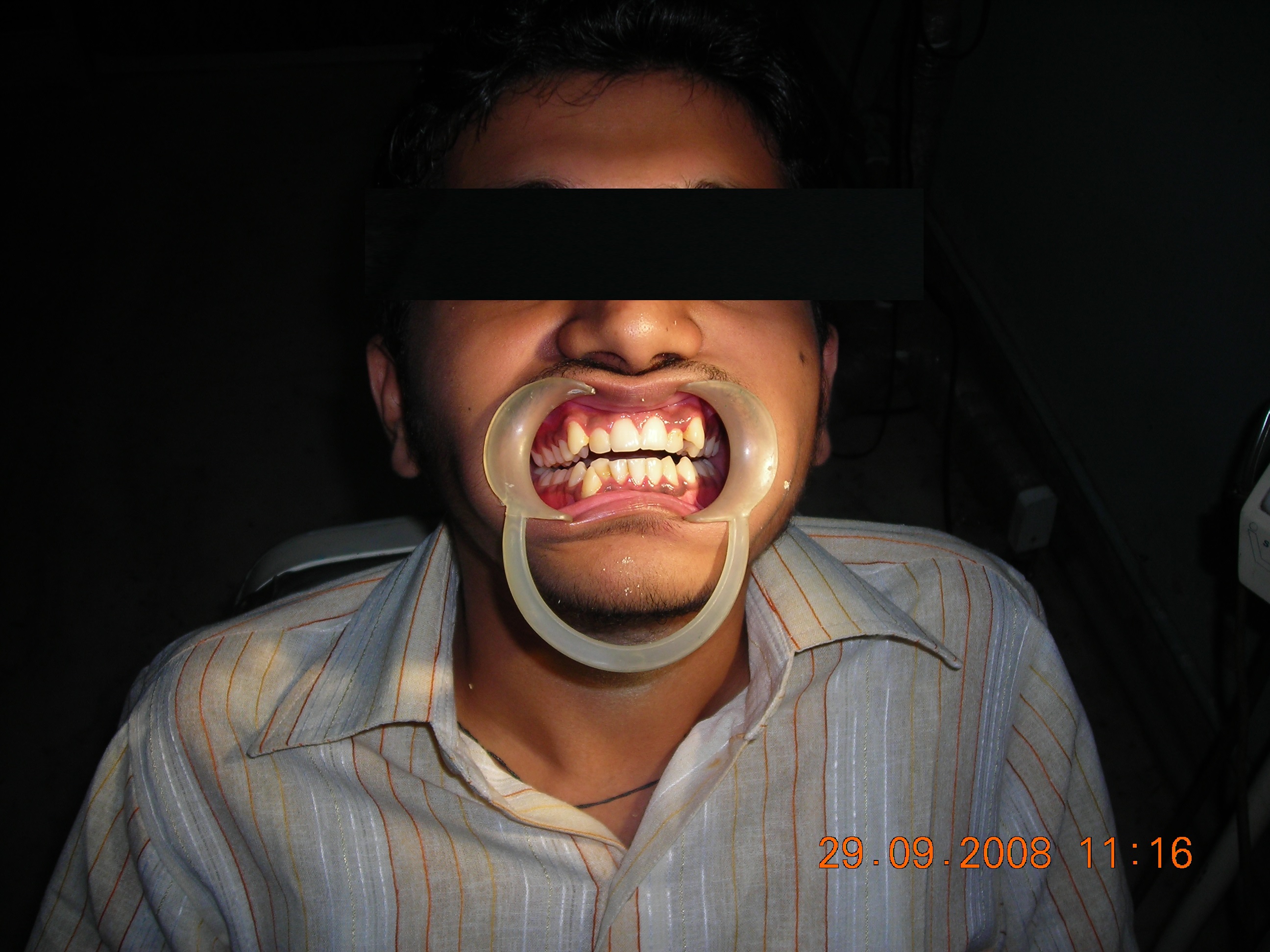 Missing Teeth Predict Strokes